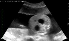 Hamilelik sırasında ilk tarama: ne zaman ve nasıl yaptıkları, sonuçların, normların ve sapmaların deşifre edilmesi