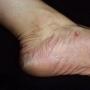 Эпидермофития ногтей. Виды эпидермофитии стоп. Лечение эпидермофитии стоп. Эпидермофития у женщин