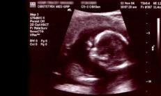 गर्भावस्था के दौरान पहली स्क्रीनिंग: निदानकर्ता क्या खोज रहे हैं?